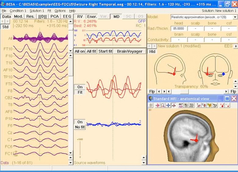 Brain Electrical Source Analysis
