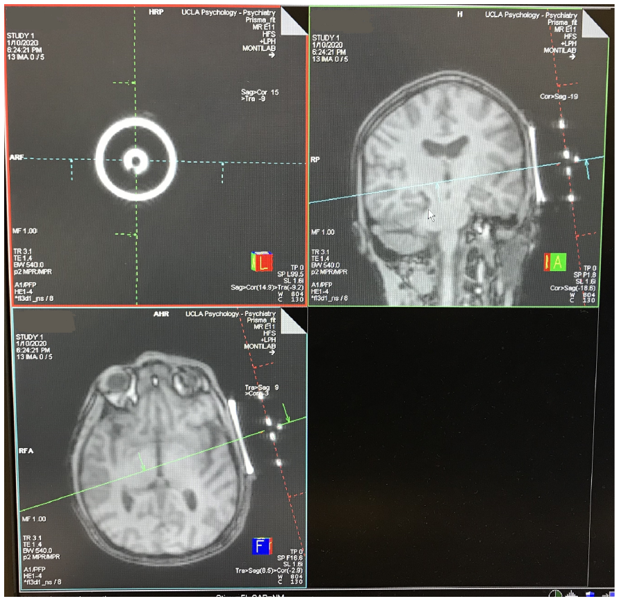 Transcranial Focused Ultrasound (tFUS) 2