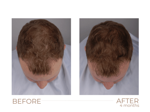 XCellarisPro Professional Hair Treatment 3