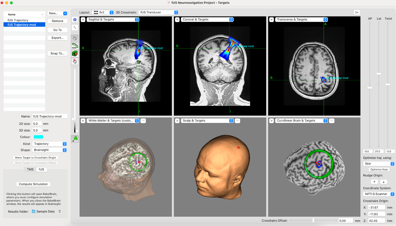 Transcranial Focused Ultrasound (tFUS) 4