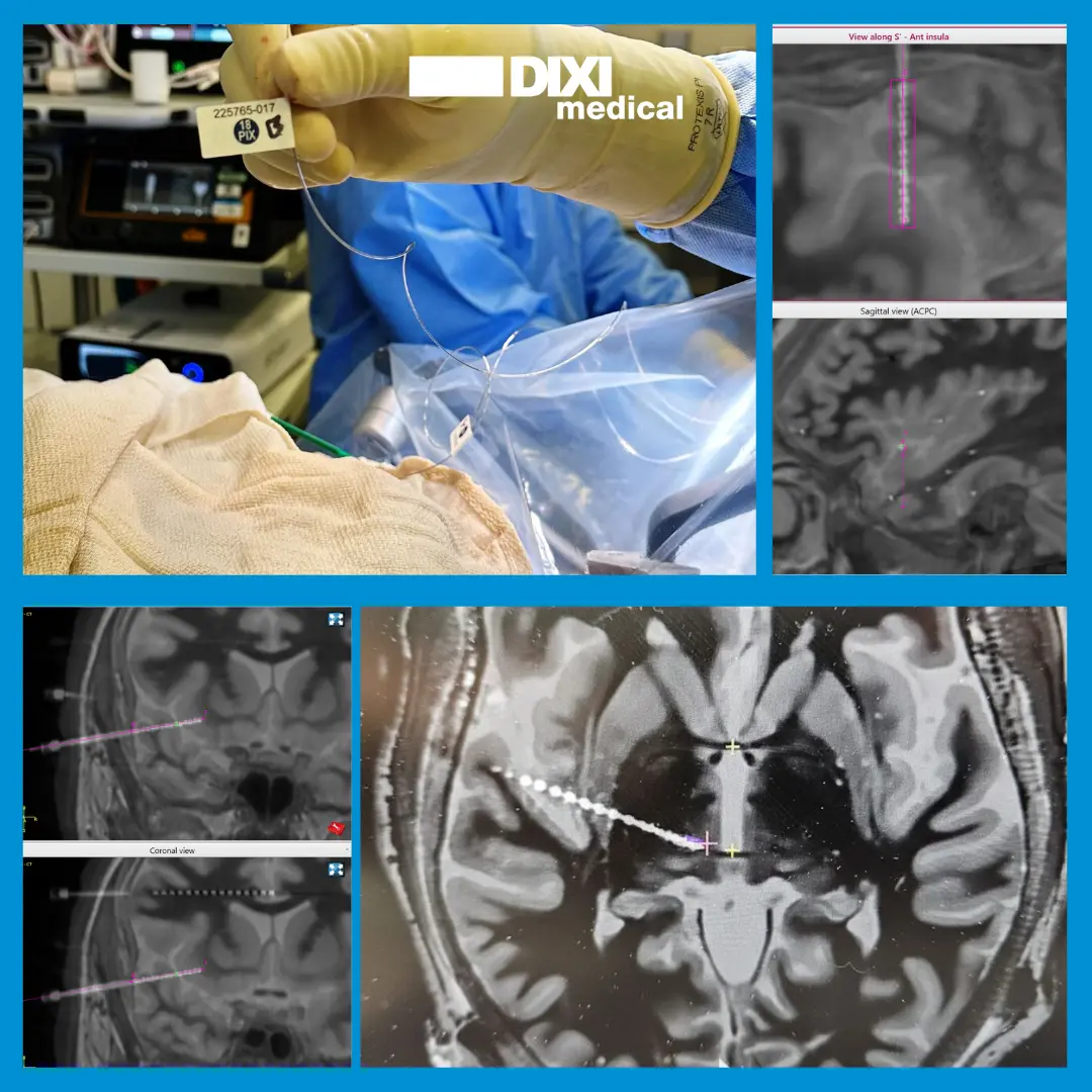 First U.S. Clinical Implantations of MICRODEEP® PIXEL Depth Electrodes