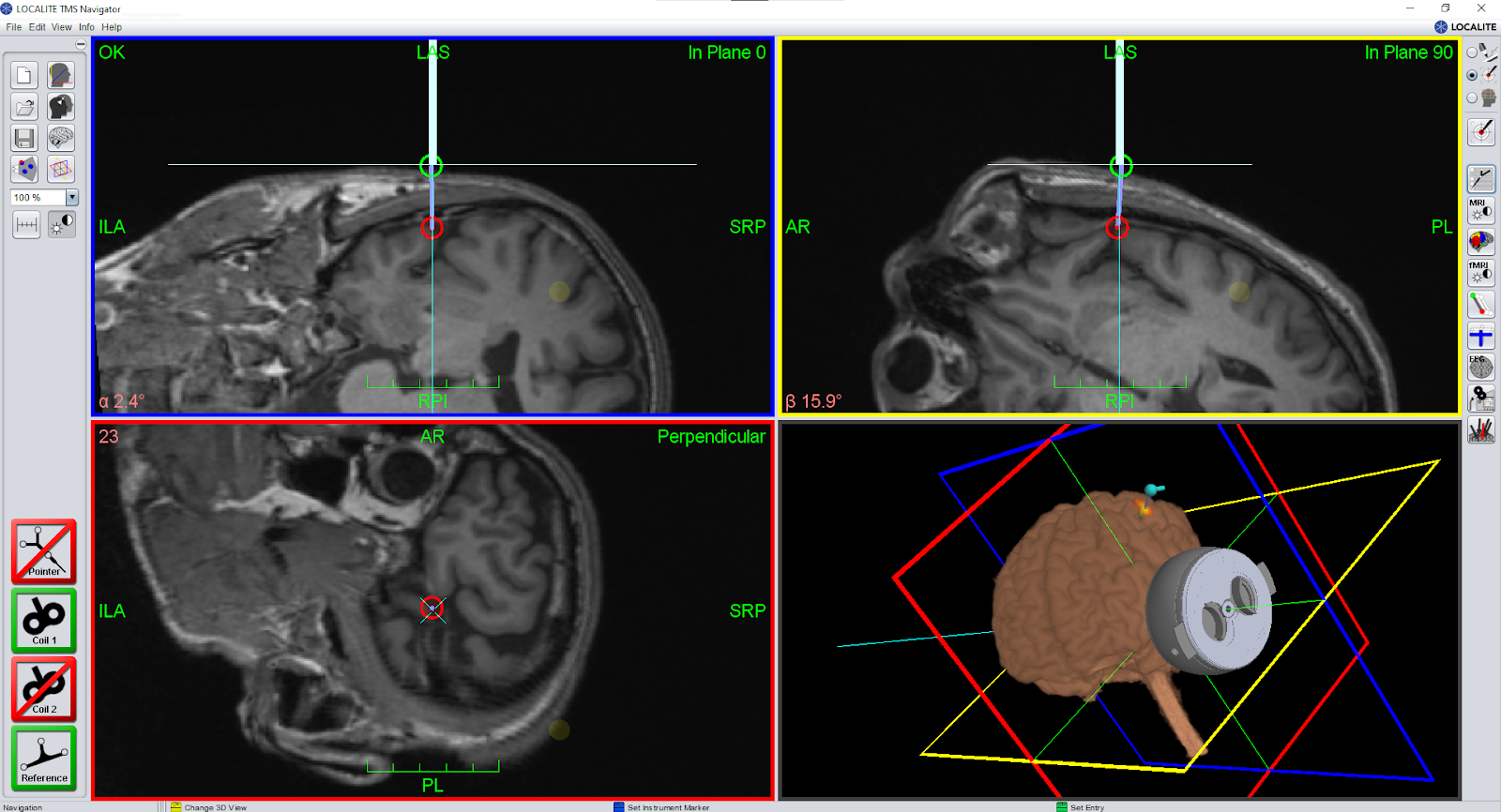Transcranial Focused Ultrasound (tFUS) 3